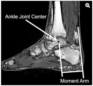 BʥͲzgT323 ]B⪺Achilles Tendon Moment Arm