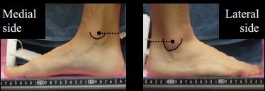 BʥͲzgT323 ]B⪺Achilles Tendon Moment Arm
