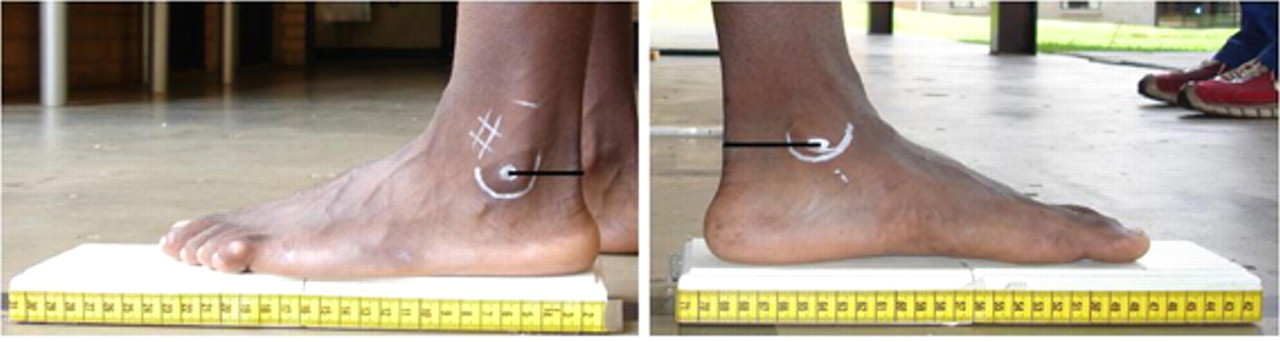 BʥͲzgT323 ]B⪺Achilles Tendon Moment Arm